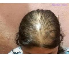 Female Baldness Treatment in Delhi