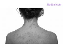 Eczema Treatment in Delhi