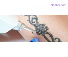 Tattoo Removal in Chandigarh