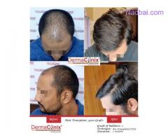 Hair Transplantation in Men - A Common Way to Hair in Empty Areas