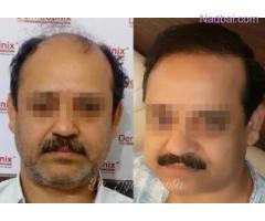 Hair Transplant Center in Delhi