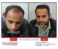 Best Hair Clinic in Delhi