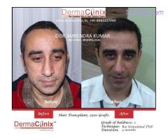 Things to be Aware About a Hair Transplant Procedure