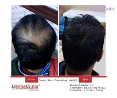 Get Affordable Hair Transplant Surgery in Delhi