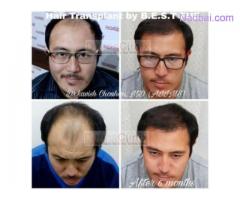 Post Hair Care Treatment After Hair Transplantation
