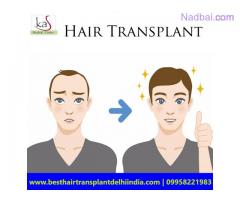 Hair Transplant in South Delhi