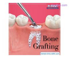 Bone Grafting in Delhi