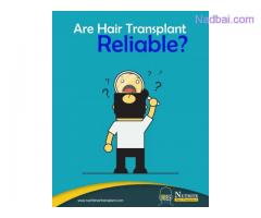 Are Hair Transplant Reliable?