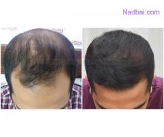 Treatment Options in Advanced Grade Baldness