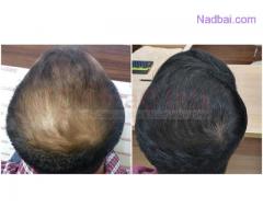 Which is the Delhi’s Cheapest & Best Hair Transplant Clinic?