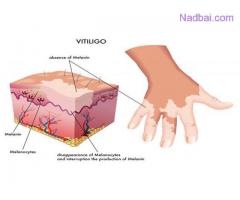 Vitiligo Treatment in Gurgaon | Skin Care World