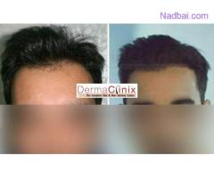 Know Little About Hair Transplantation Surgical Treatment