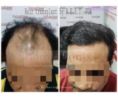 How Does Hair Transplant Work